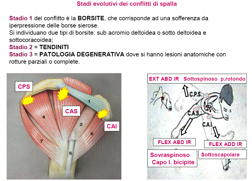 Conflitto Spalla