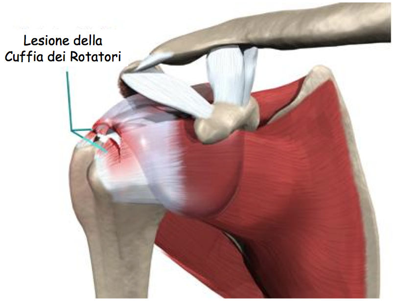 Lesione_Spalla_Rotatori