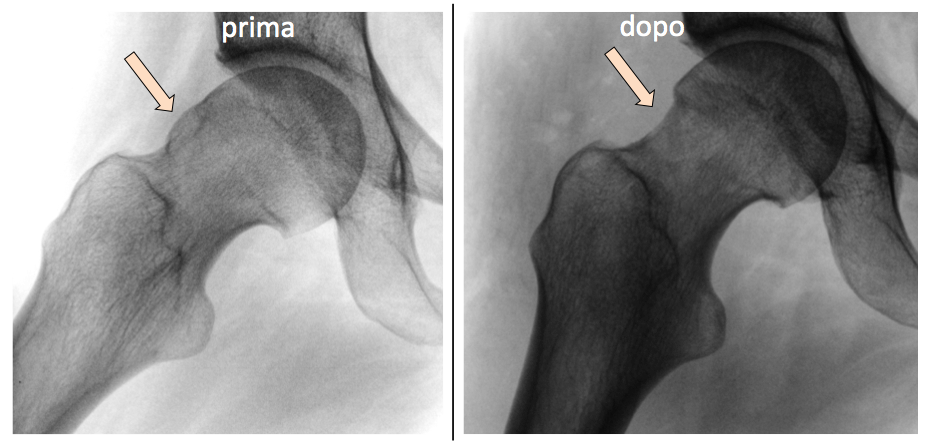 Osteopatia Collo Femore