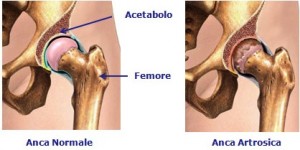 coxartrosi-anca