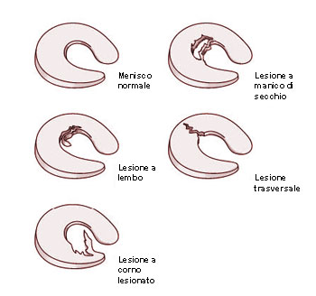 lesioni meniscali 2