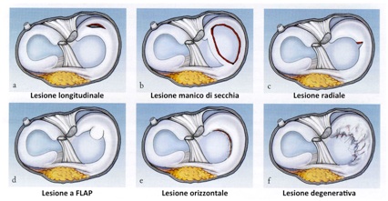 lesioni meniscali