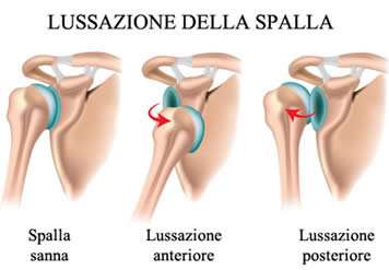 lussazione-spalla