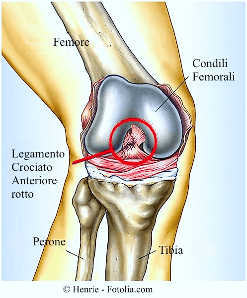 rottura-legamenti-ginocchio
