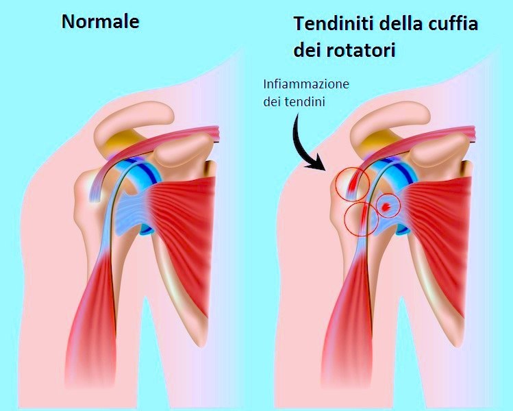 tendinite spalla